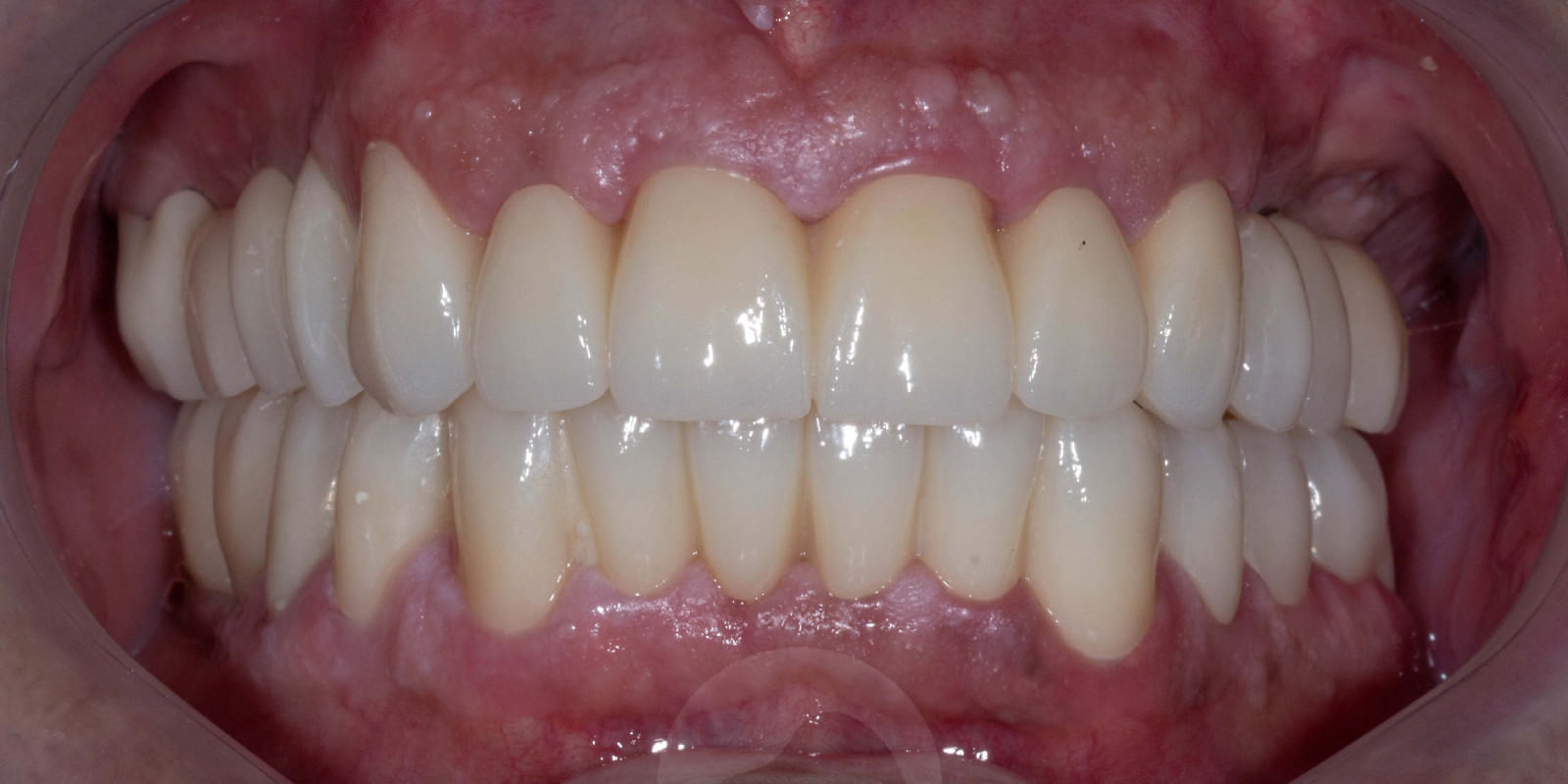 Zirconia Crowns