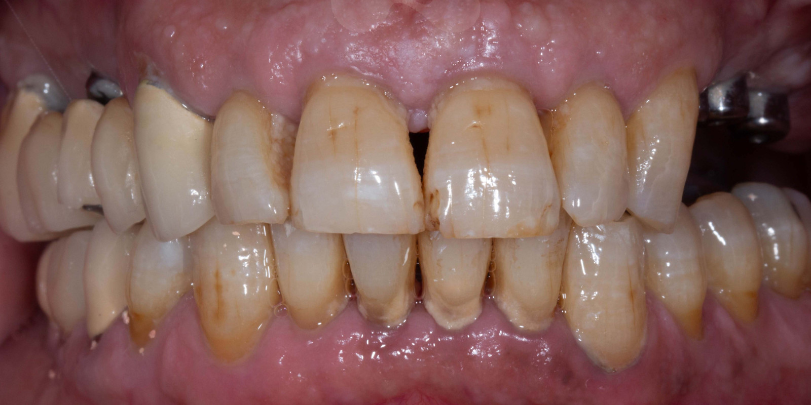 Zirconia Crowns