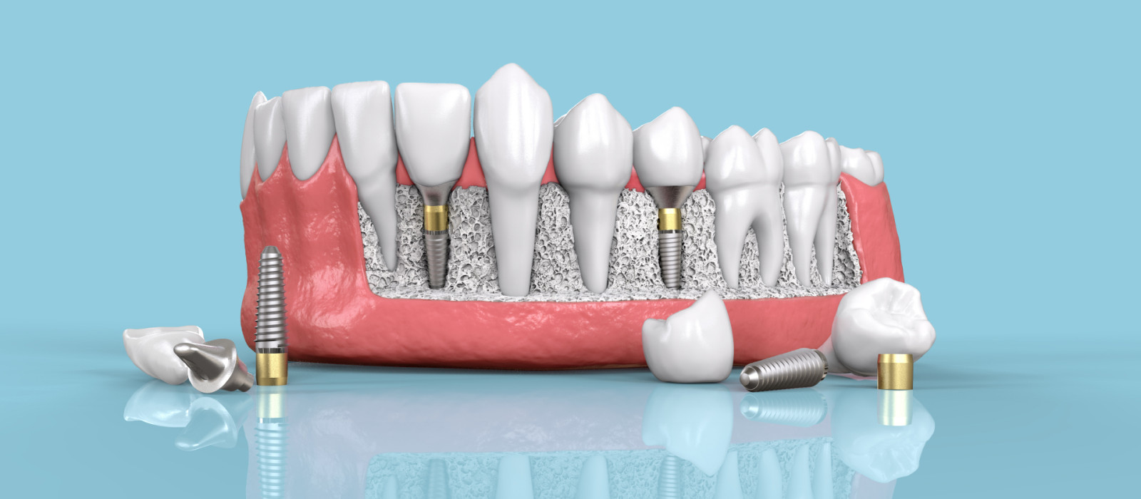 Dental Implantation Process